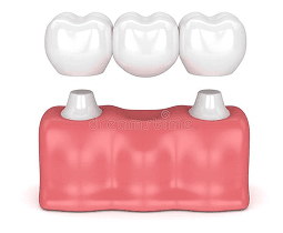 بریج دندانی