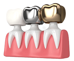 روکش دندانی