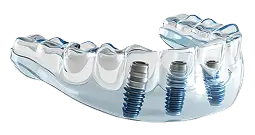 ایمپلنت اوردنچر