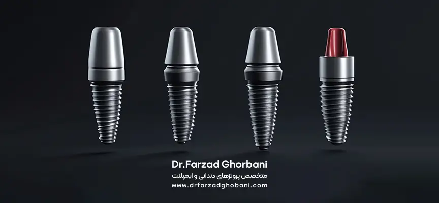 انواع ایمپلنت-دکتر فرزاد قربانی