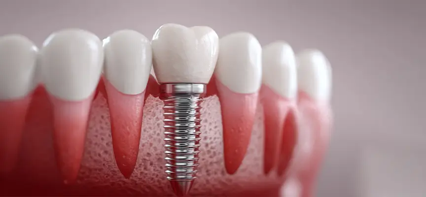 مراقبت‌های بعد از درمان ایمپلنت فوری دندان-دکتر فرزاد قربانی متخصص ایمپلنت فوری در تهران