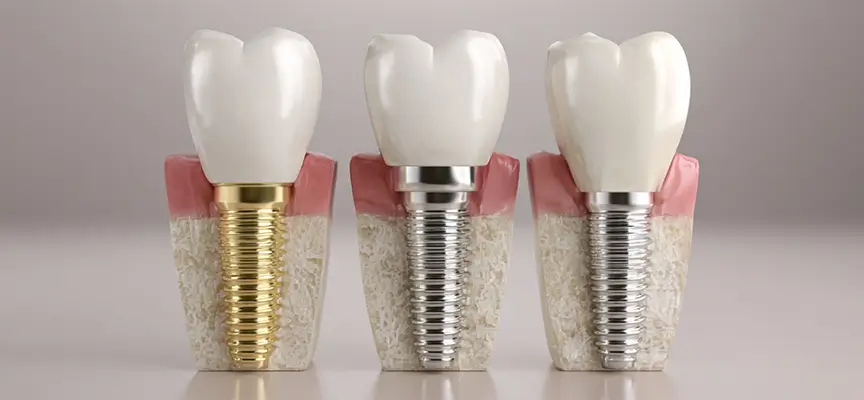 انواع ایمپلنت دندان و برندها- دکتر فرزاد قربانی متخصص ایمپلنت